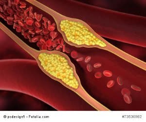 Arteriosklerose - Ursachen, Symptome, Therapie