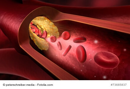 Arteriosklerose - Ursachen, Symptome, Therapie